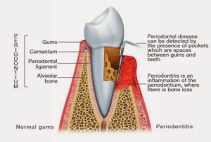 periodontitis_illustration