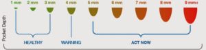 stages-of-gum-disease